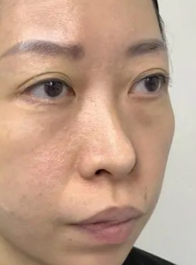 去眼袋手术