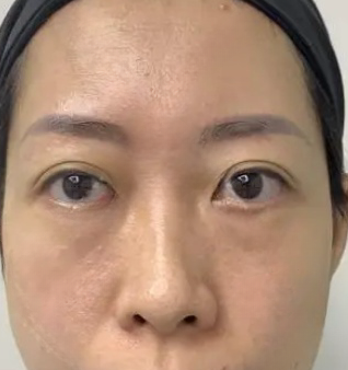 去眼袋手术