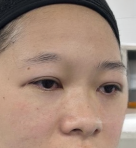 去眼袋手术