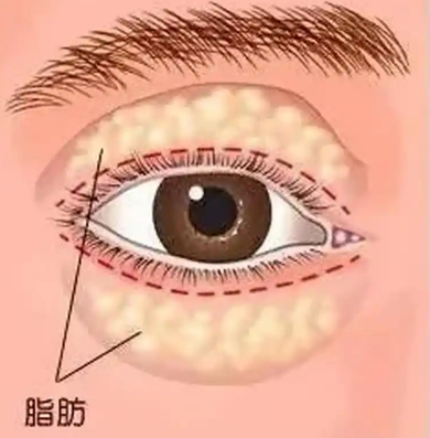 去眼袋手术