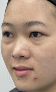 去眼袋手术