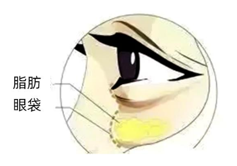 去眼袋手术