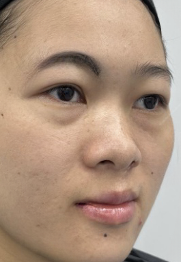 去眼袋手术