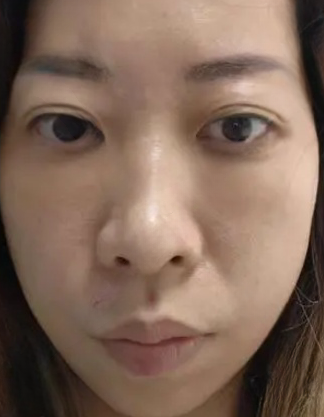 去眼袋手术