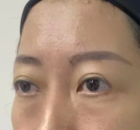去眼袋手术