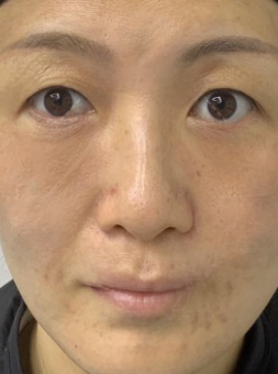 去眼袋手术