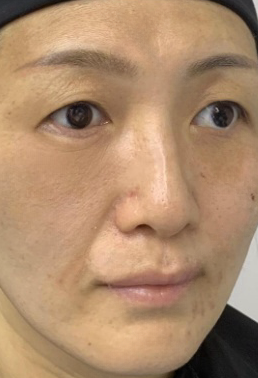 去眼袋手术