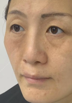 去眼袋手术