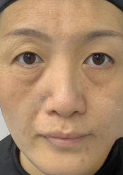 去眼袋手术