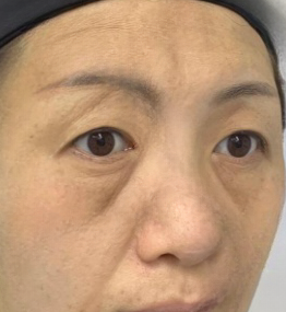 去眼袋手术