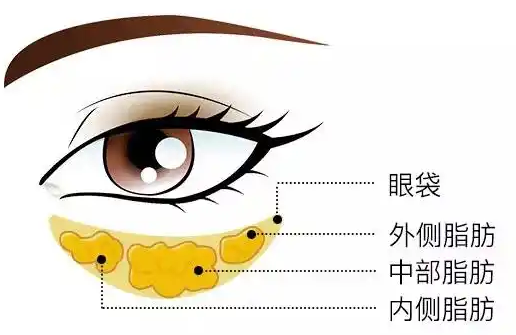 去眼袋手术