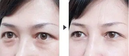 去眼袋手术