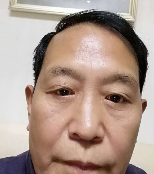 去眼袋手术