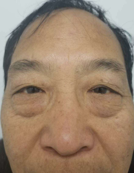 去眼袋手术
