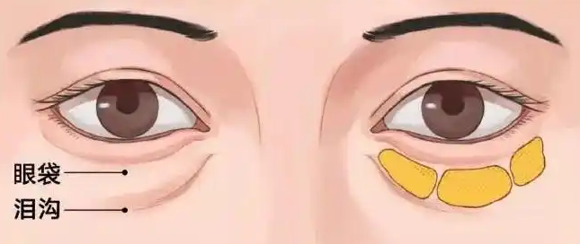 去眼袋手术