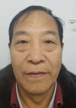 去眼袋手术