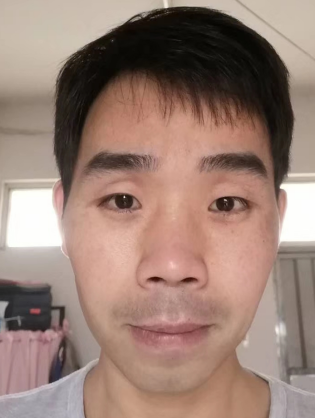 去眼袋手术