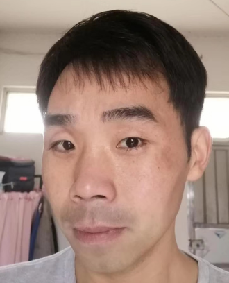 去眼袋手术