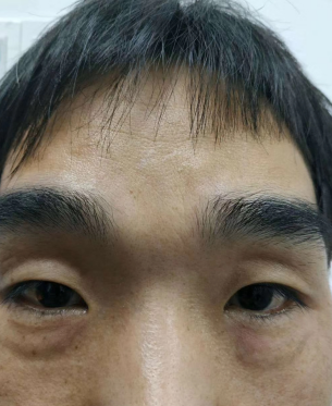 去眼袋手术