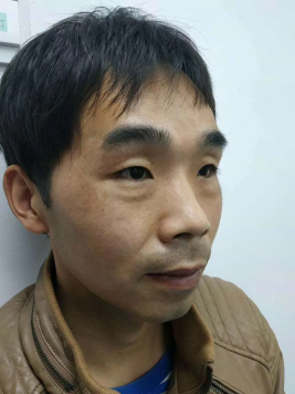 去眼袋手术