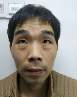 去眼袋手术