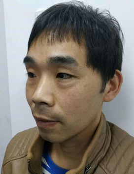 去眼袋手术