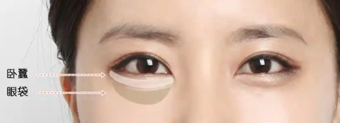 去眼袋手术