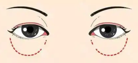 眼袋