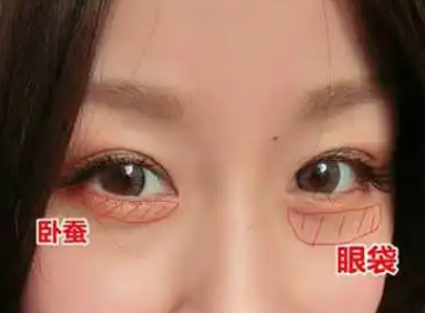 眼袋
