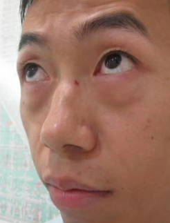 去眼袋手术