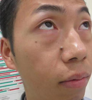 去眼袋手术