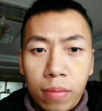 去眼袋手术