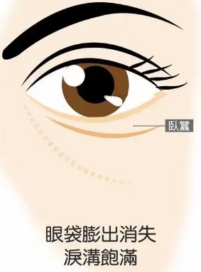 去眼袋手术
