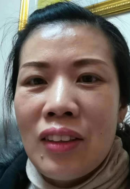 去眼袋手术