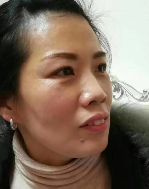 去眼袋手术