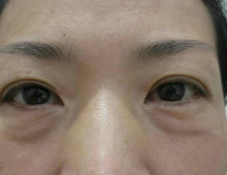 去眼袋手术