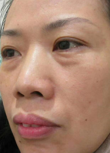 去眼袋手术