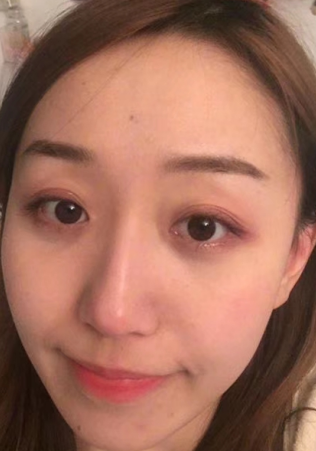 去眼袋手术