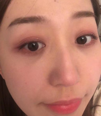 去眼袋手术