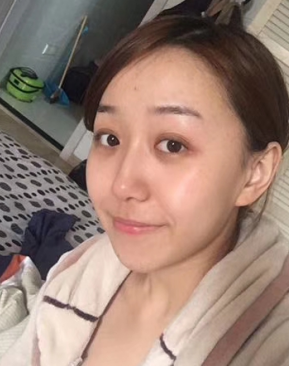 去眼袋手术