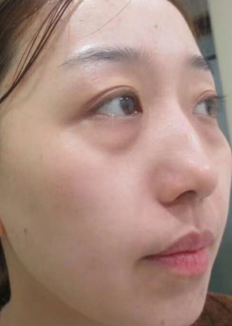 去眼袋手术