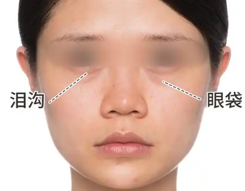去眼袋手术