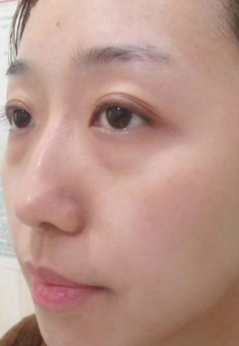 去眼袋手术