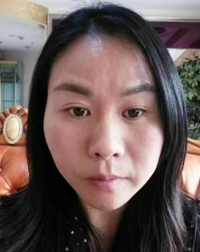 去眼袋手术