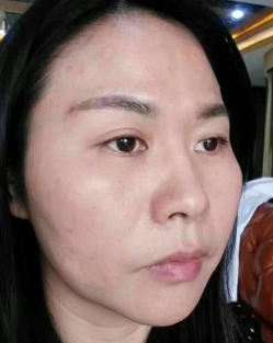 去眼袋手术
