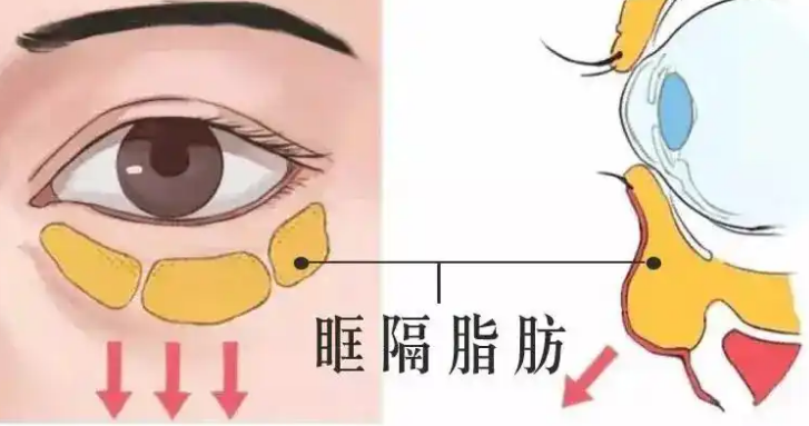 去眼袋手术