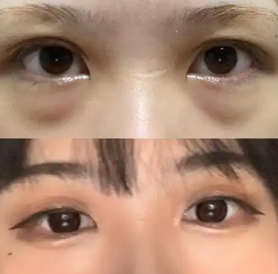 去眼袋手术