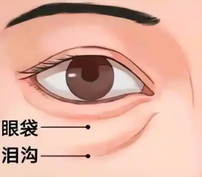 去眼袋手术