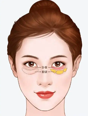 去眼袋手术