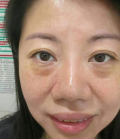 去眼袋手术